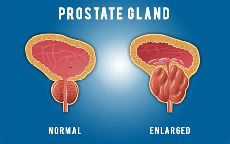 prostate